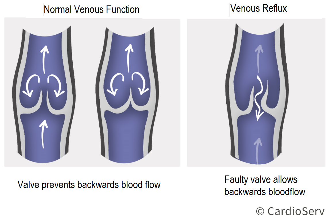 Intro to Venous Reflux