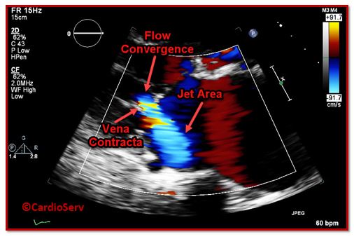 Mitral Regurgitation Color Doppler Components