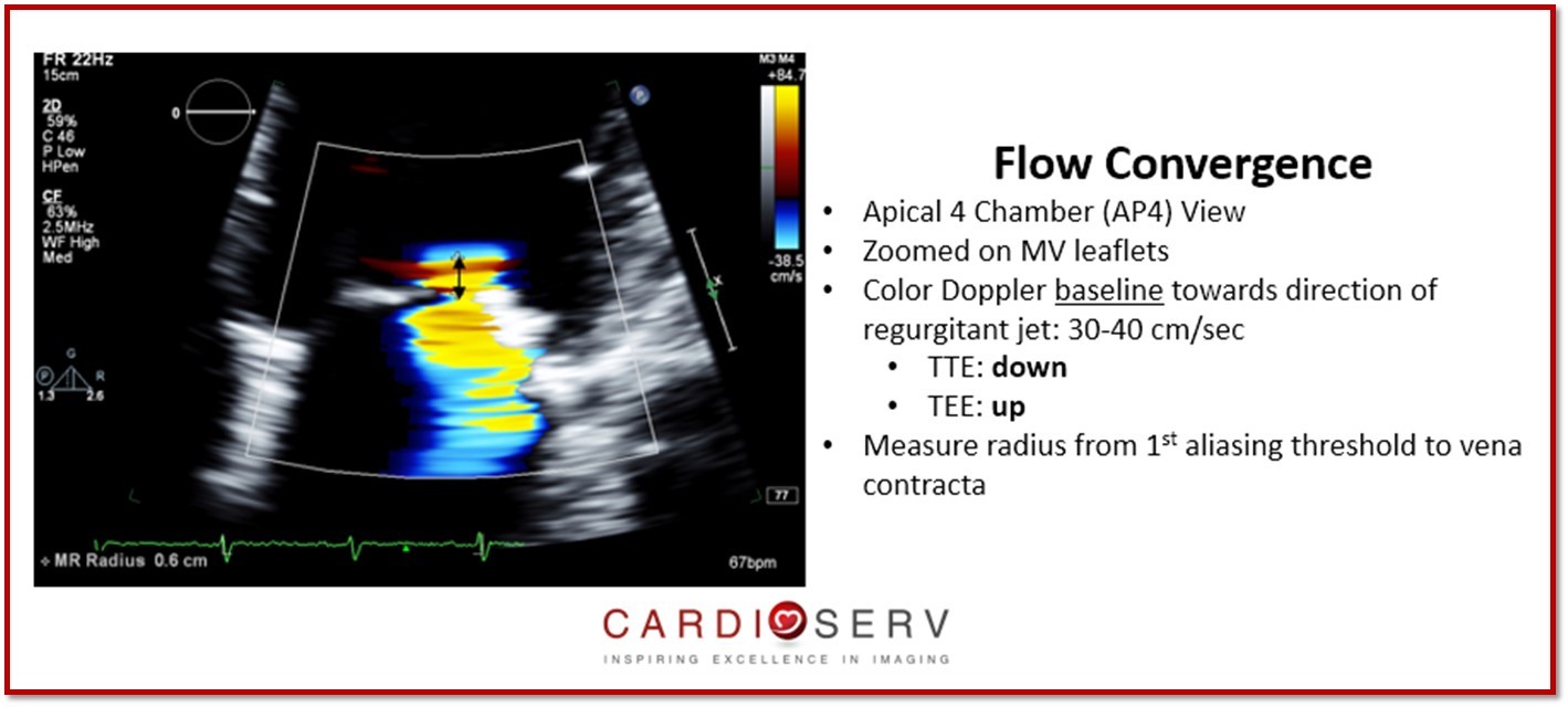 Flow Convergence Mitral Regurgitation