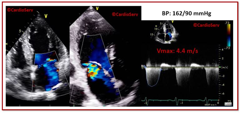 HTN Mitral Regurgitation Echo Example 