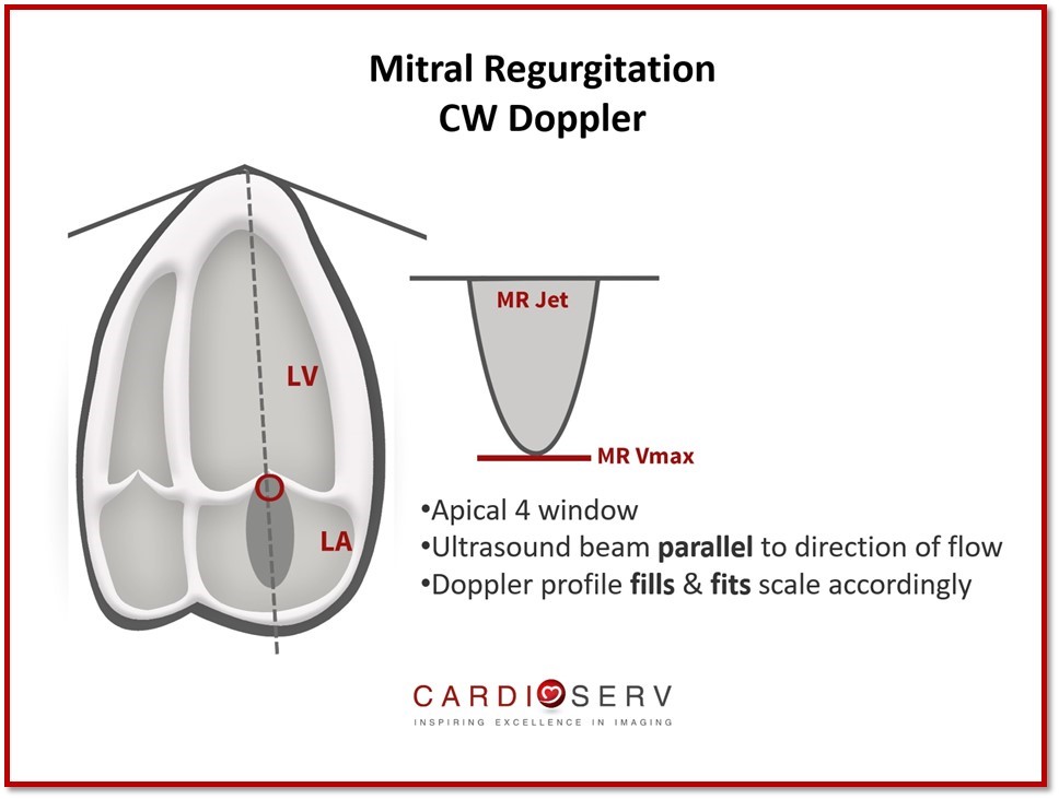 Mitral Regurgitation CW Doppler