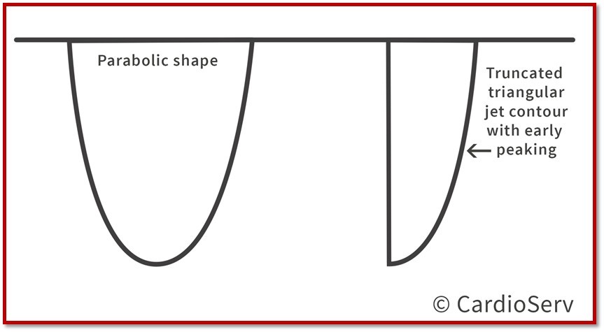 Mitral Regurgitation Jet Profile