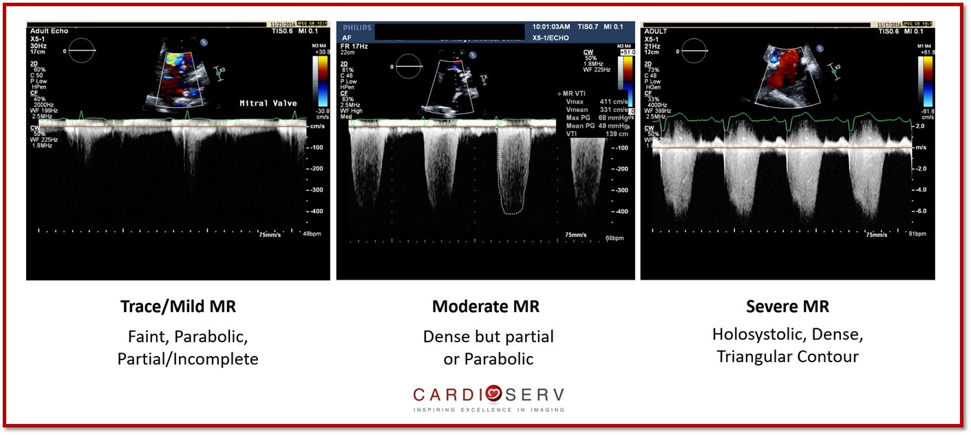 Mitral Regurgitation Jet Profile