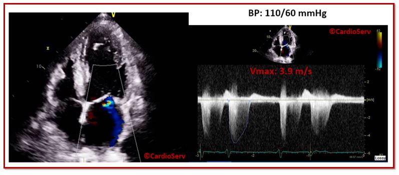 Normal BP MR Echo Example