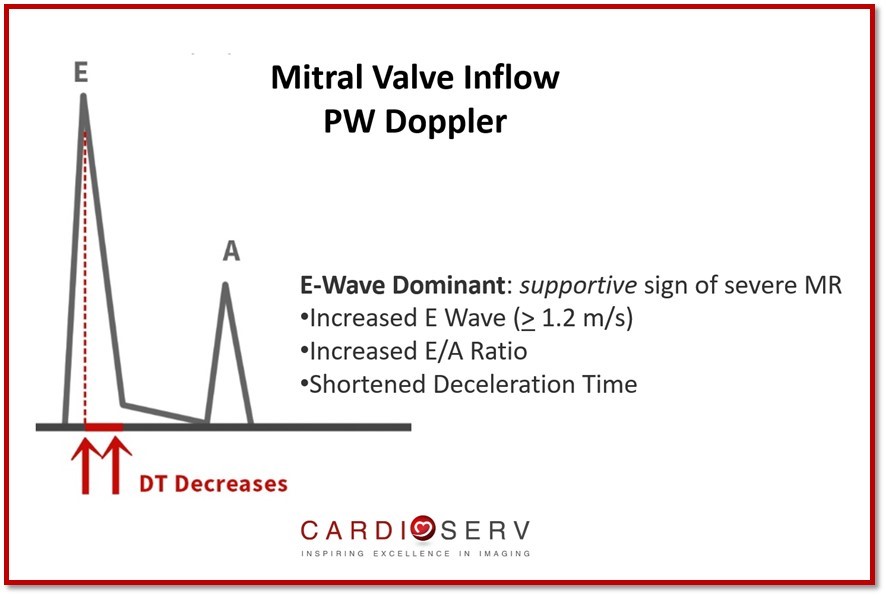 Mitral Valve PW Inflow 