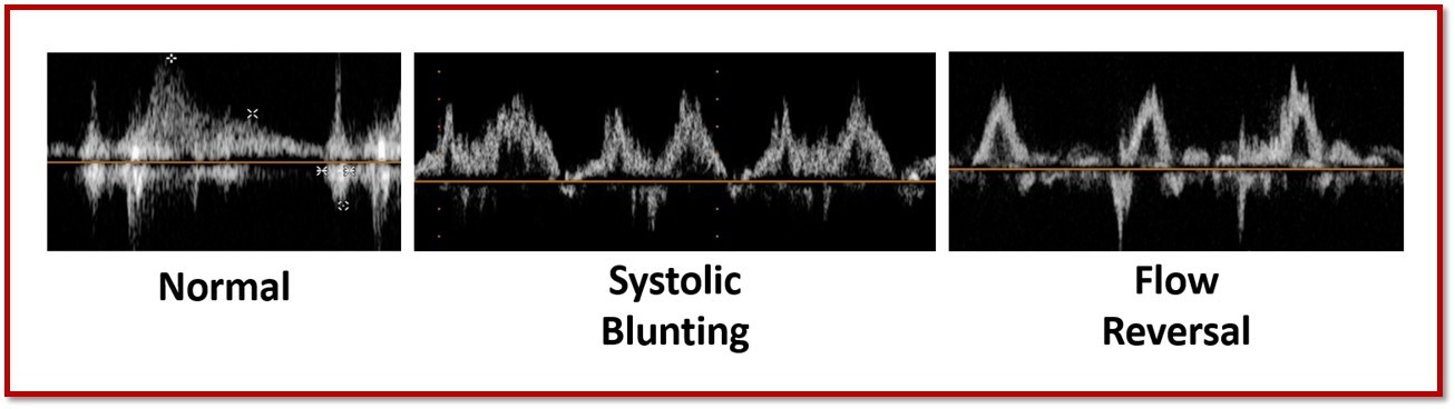 Pulmonary Vein Flow