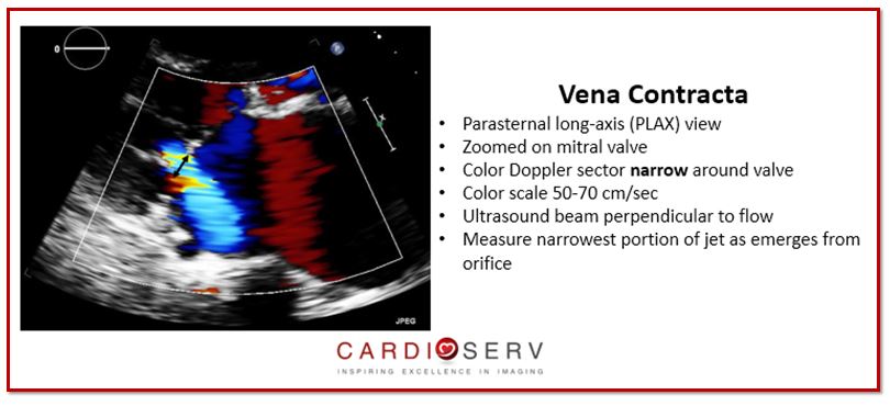 Vena Contracta mitral regurgitation 