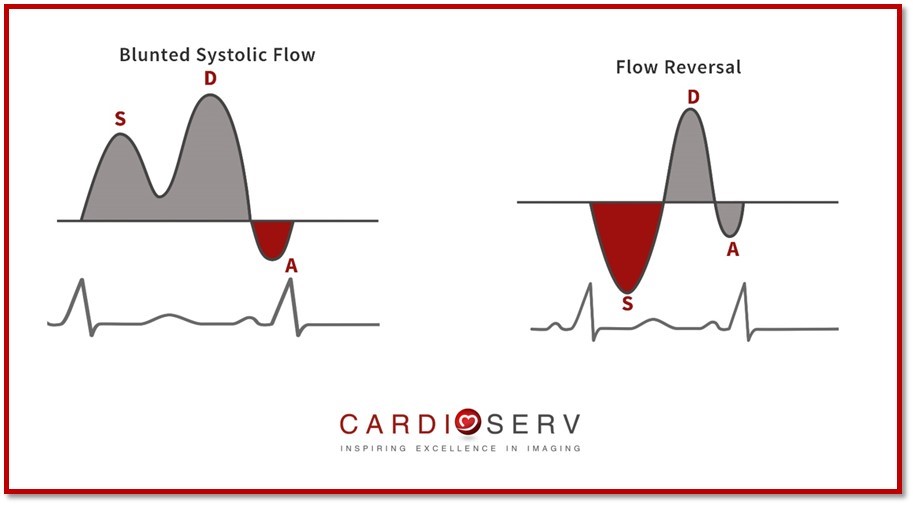 Pulmonary Vein Waveforms