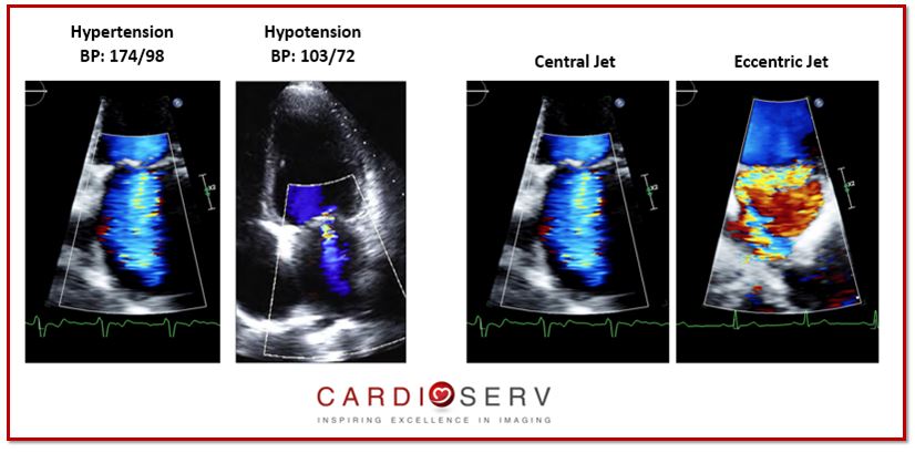 Mitral Regurgitation Color Doppler flow Factors