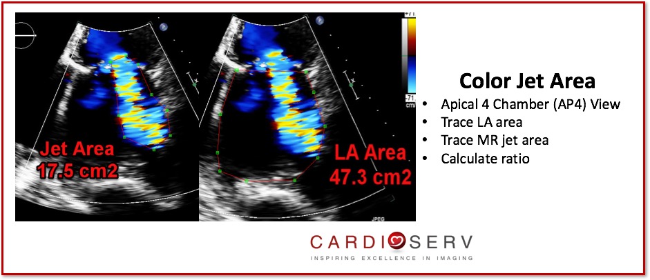 Color Jet Area Mitral Regurgitaiton