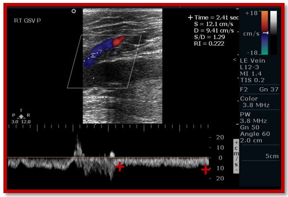 What’s wrong with this image? Venous Reflux