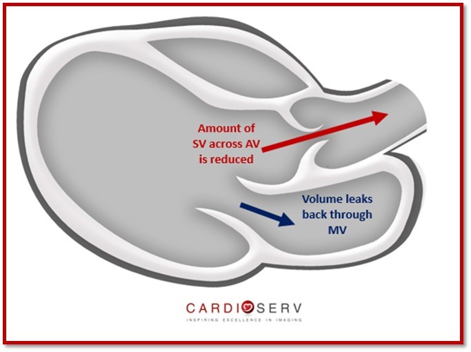 Mitral Valve Stroke Volume