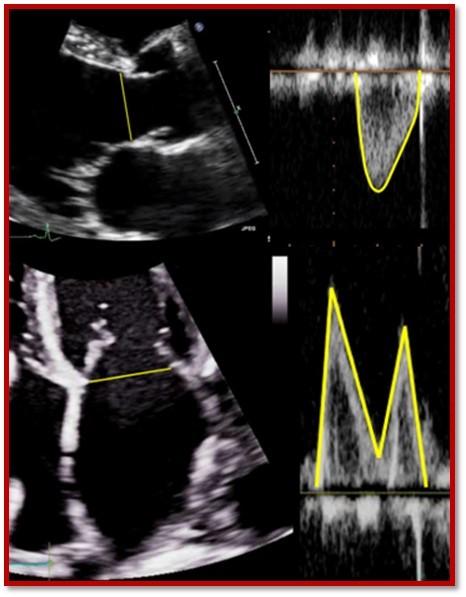 3 Steps to Quantifying MR via Stroke Volume Method!