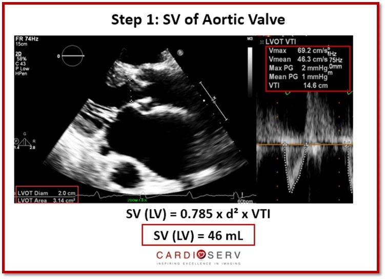 Stroke Volume LV