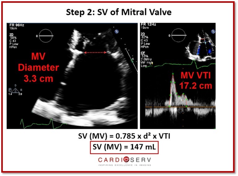 Stroke Volume Mitral Valve