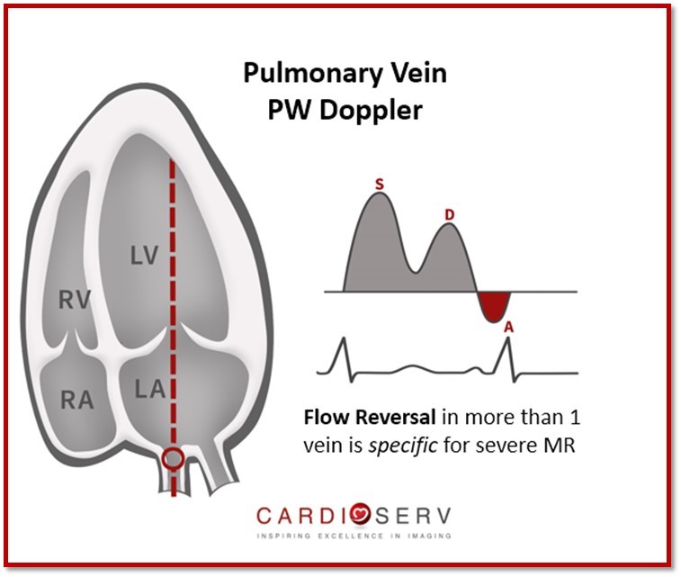 Pulmonary Veins for MR
