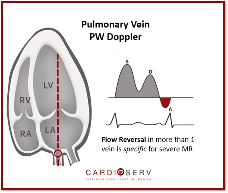 Understanding the Basics: LV Filling Patterns Cardioserv