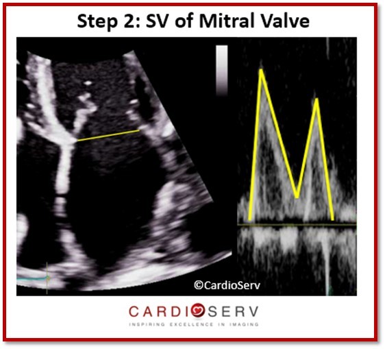 MR Stroke Volume Mitral Valve