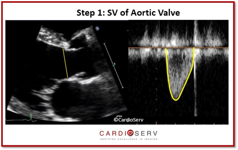 MR Stroke Volume Aortic Valve