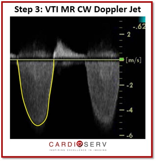 MR Stroke Volume MR VTI