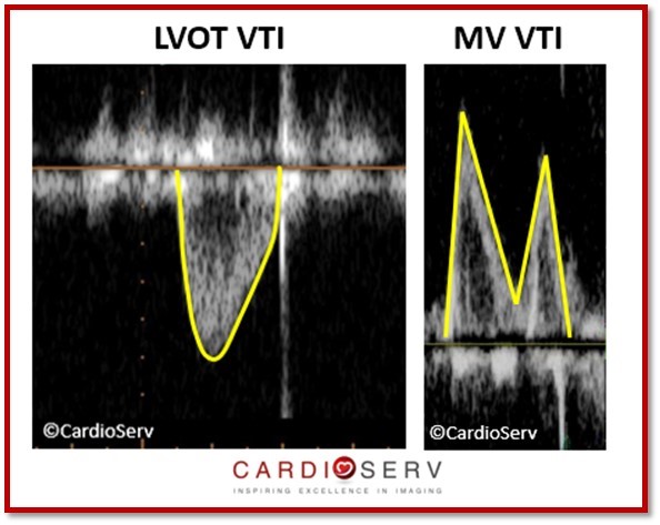 Stroke Volume VTI Measurement