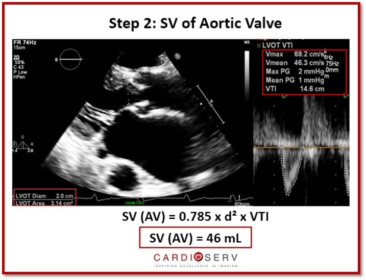 Step 2: Stroke Volume of Aortic Valve