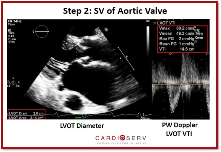 Stroke Volume of Aortic Valve