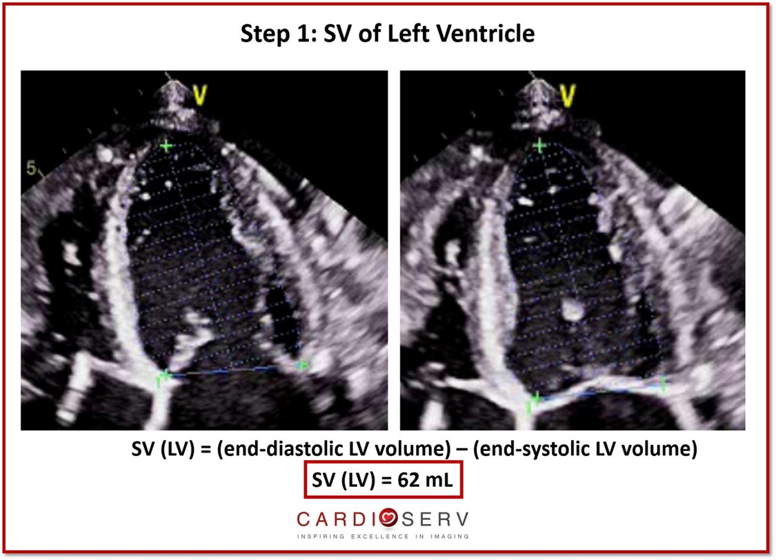 SV of LV