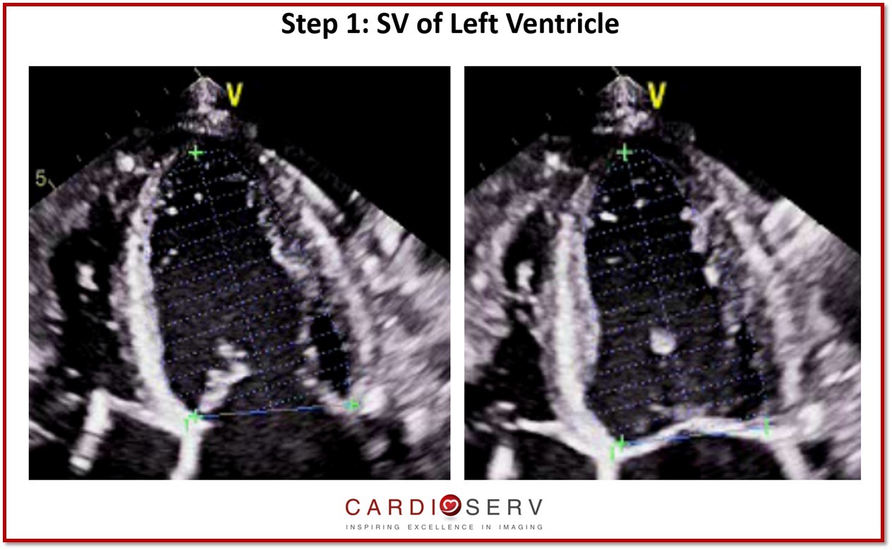 Volumetric Method:  A Third method for evaluating MR severity!