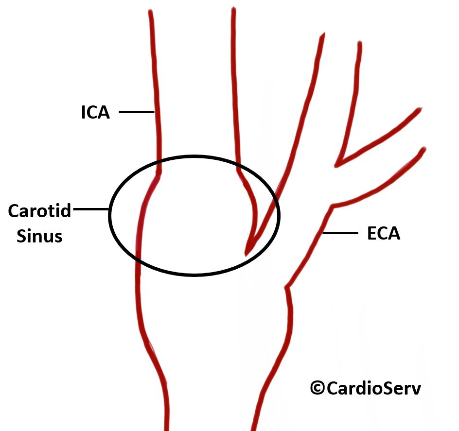 Carotid sinus