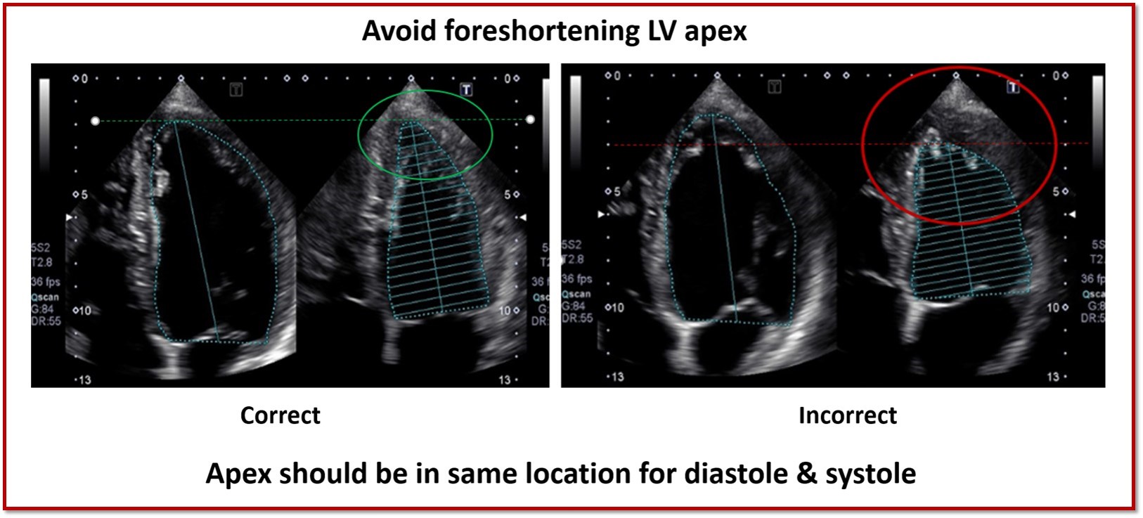 Let&#39;s Talk Left Ventricle Bi-Plane Volume Measurements!