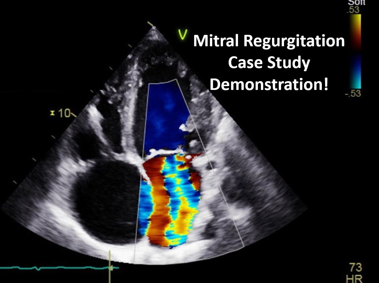 Mitral Regurgitation Case Study Demonstration!