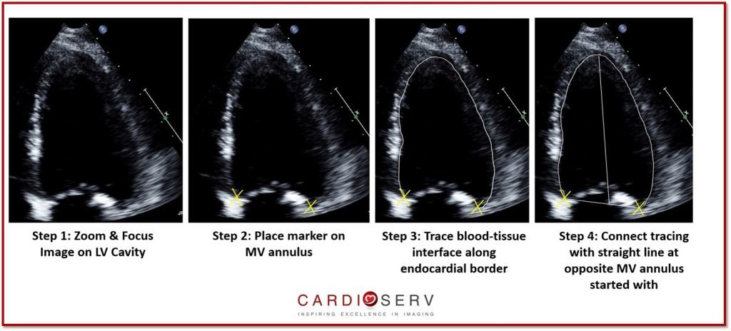 Case 43: Significant Spontaneous Echo Contrast In Left Ventricle (  DCM/Severe LV Dysfunction / LVEF : 15% in M- Mode / LVEF : 10% In Simpson's  Method., By Interesting cases in Echocardiography