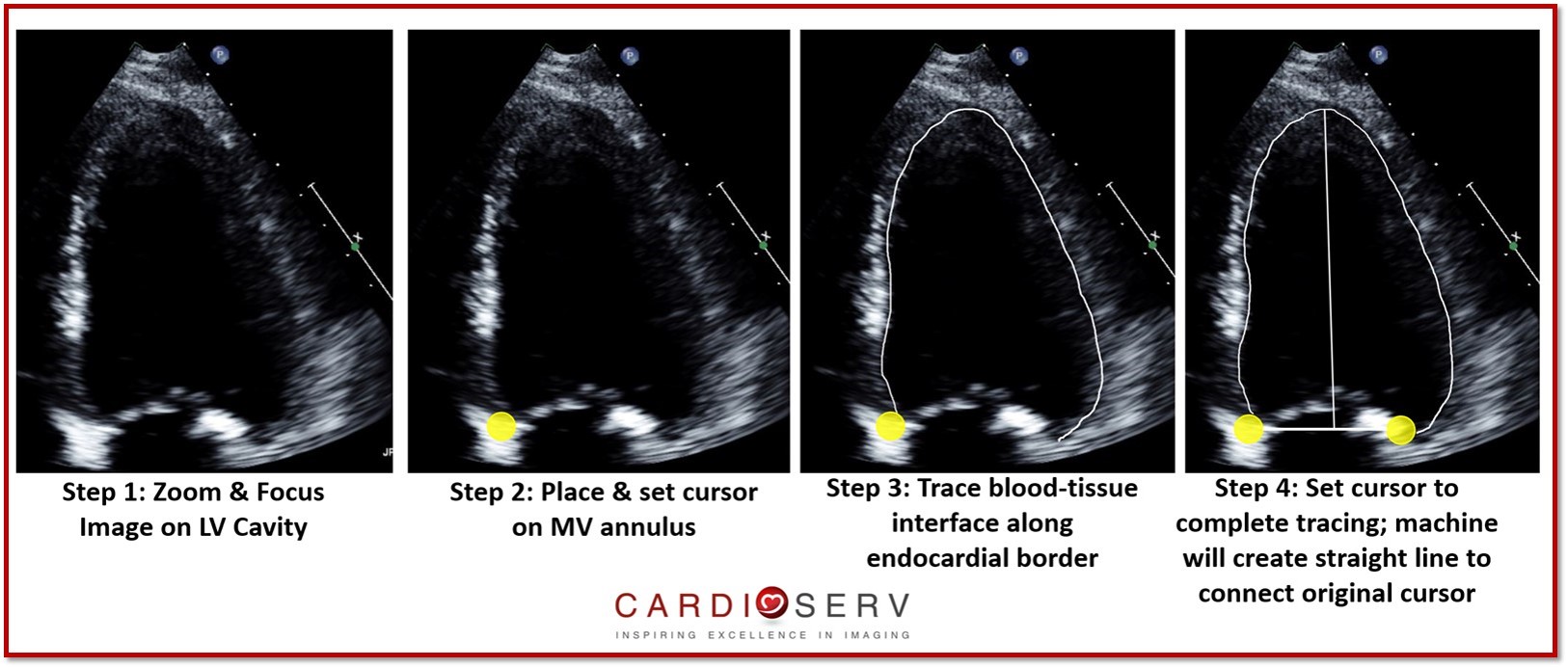 Let&#39;s Talk Left Ventricle Bi-Plane Volume Measurements!