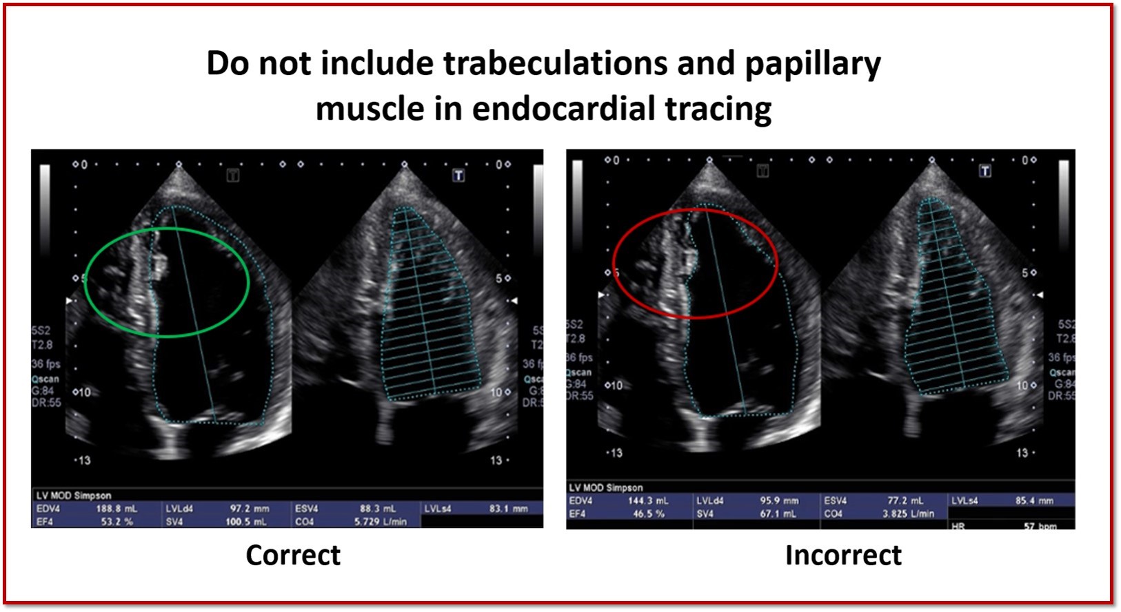 Let&#39;s Talk Left Ventricle Bi-Plane Volume Measurements!