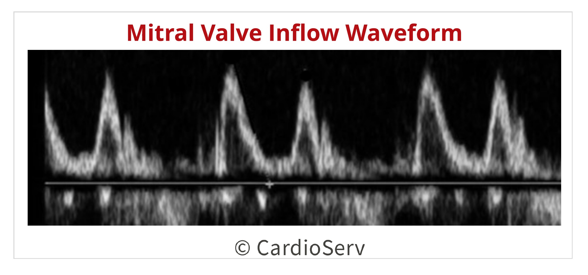 Mitral Valve Pulsed Wave Doppler Inflow 