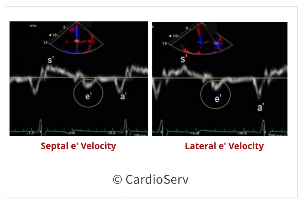 PW TDI Diastolic Function Measurement