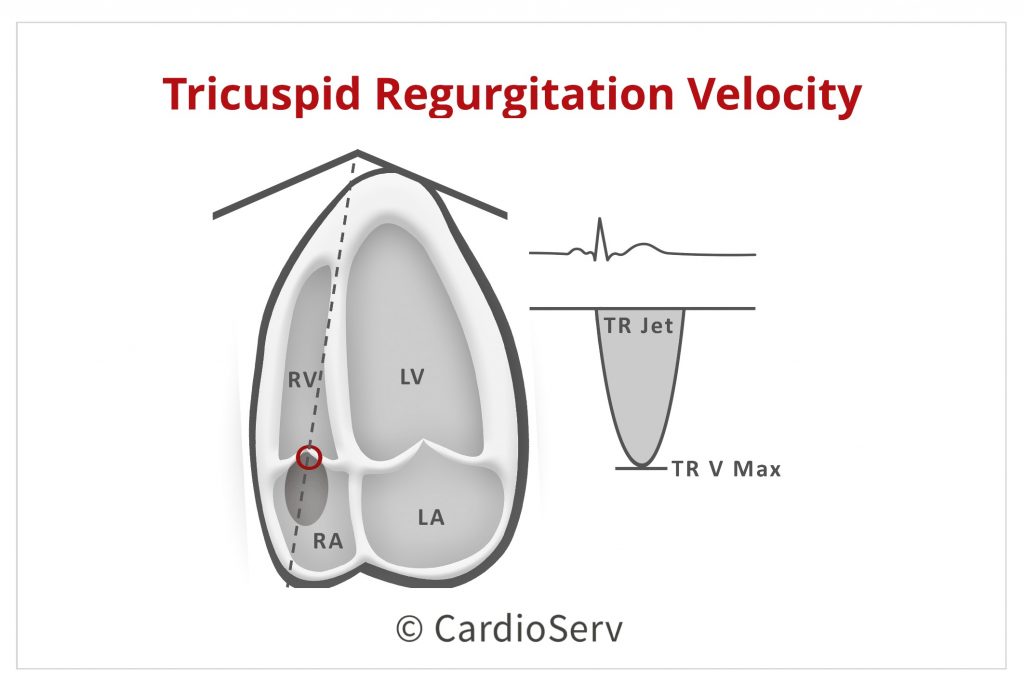 E/A reversal on Doppler echo in LV diastolic dysfunction – All