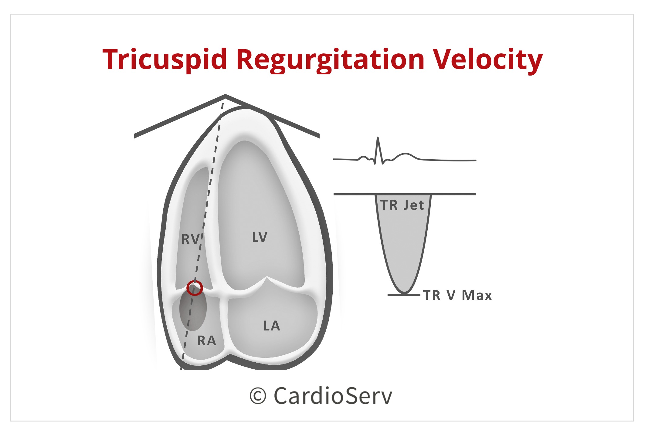 Specific Echo Parameters that Indicate Elevated LAP Cardioserv