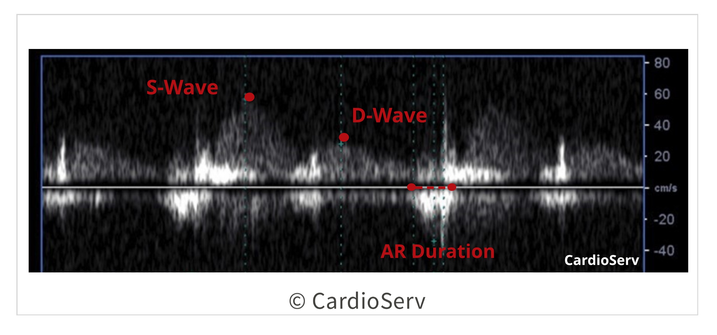 pulmonary vein measurement