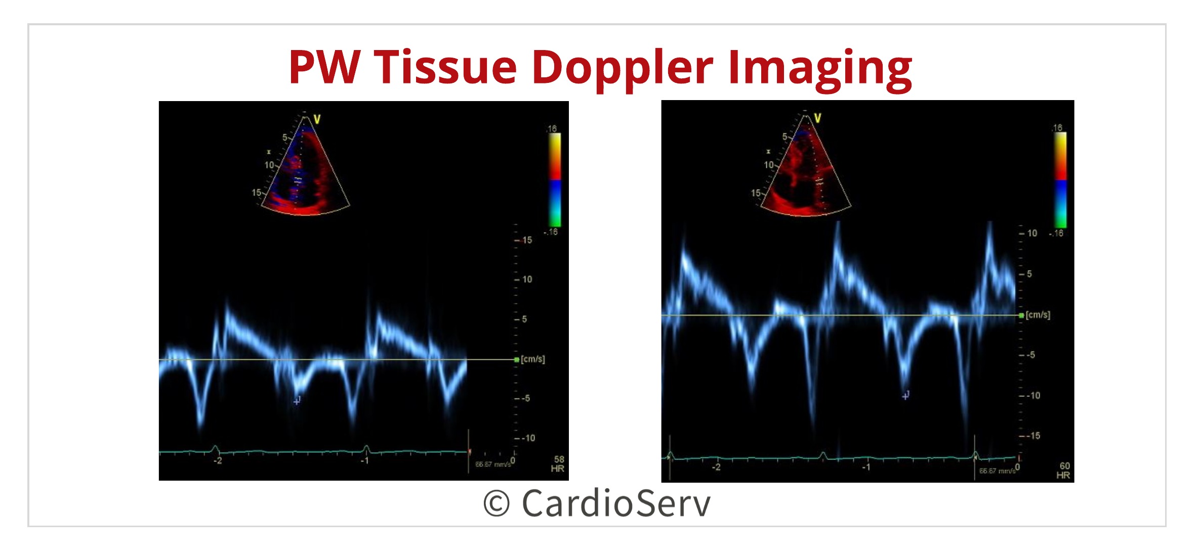 Pulsed Wave Doppler Tissue Doppler Imaging Diastolic Function Waveforms