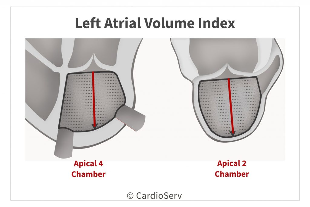 Left Atrial Volume Index in echo