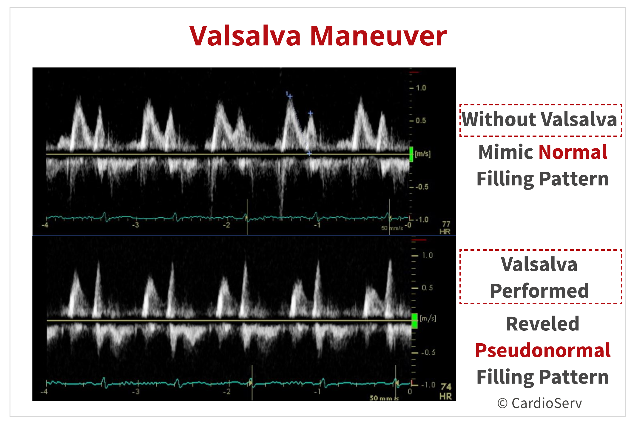 Valsalva Maneuver with Diastolic Function