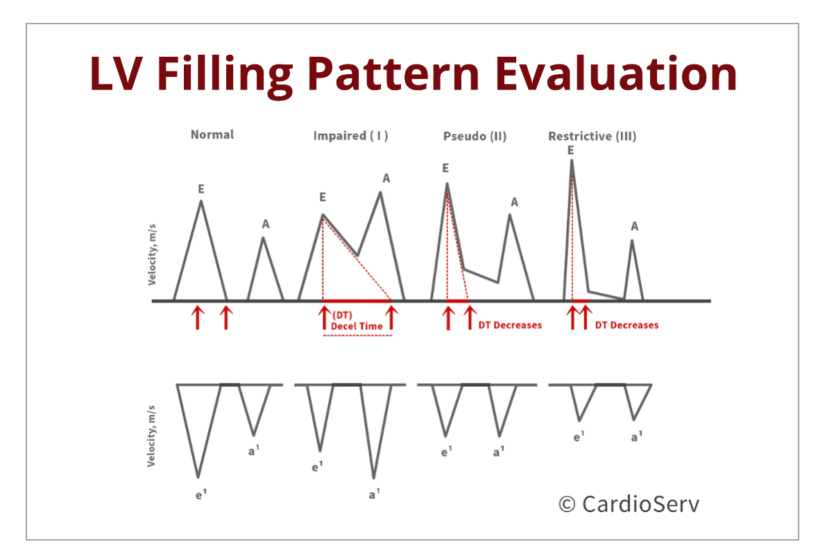 Understanding the Basics: LV Filling Patterns