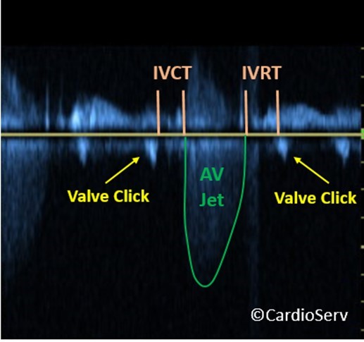 Aortic Valve Velocity Valve Clicks