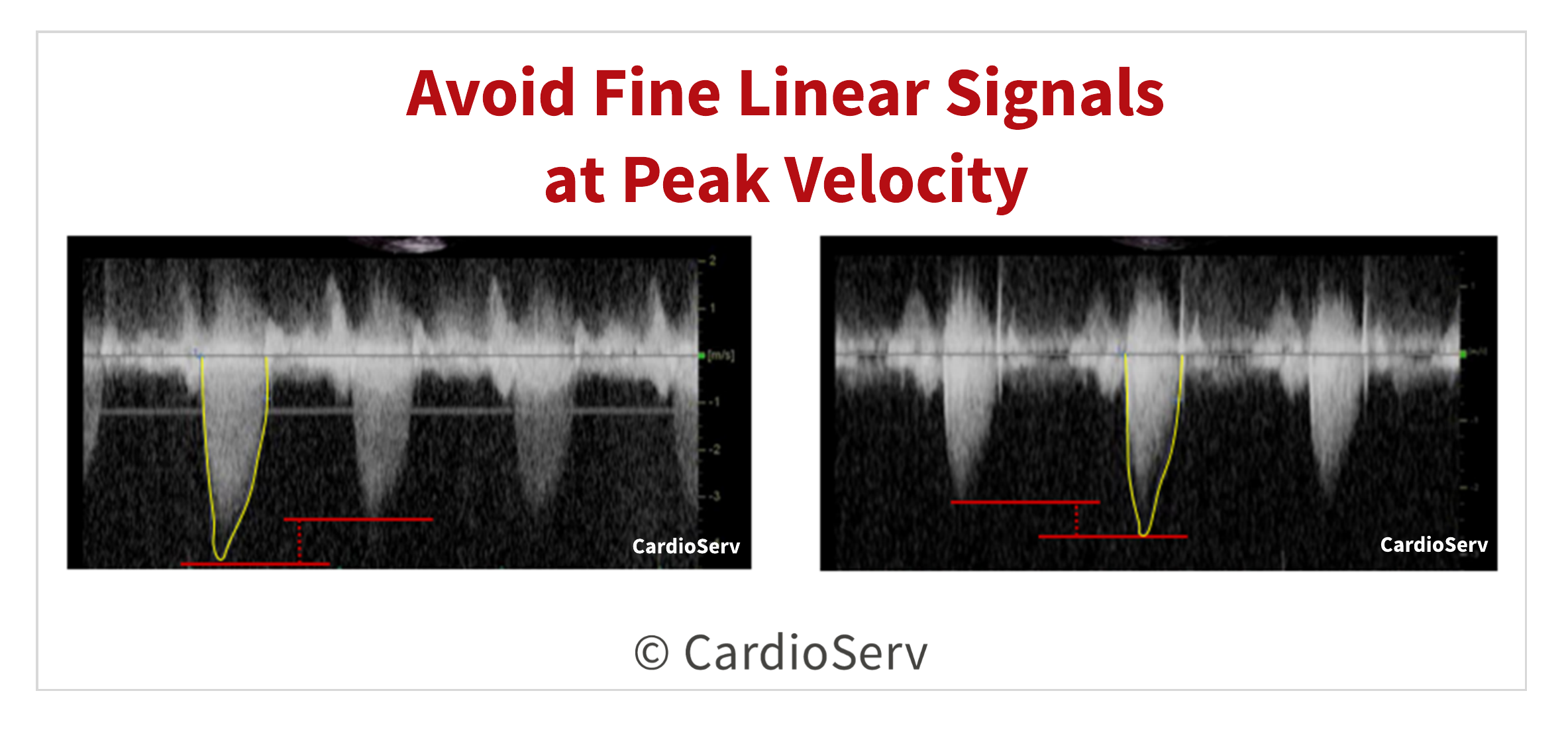 Avoid Linear Signals Aortic Valve Velocity Tracing