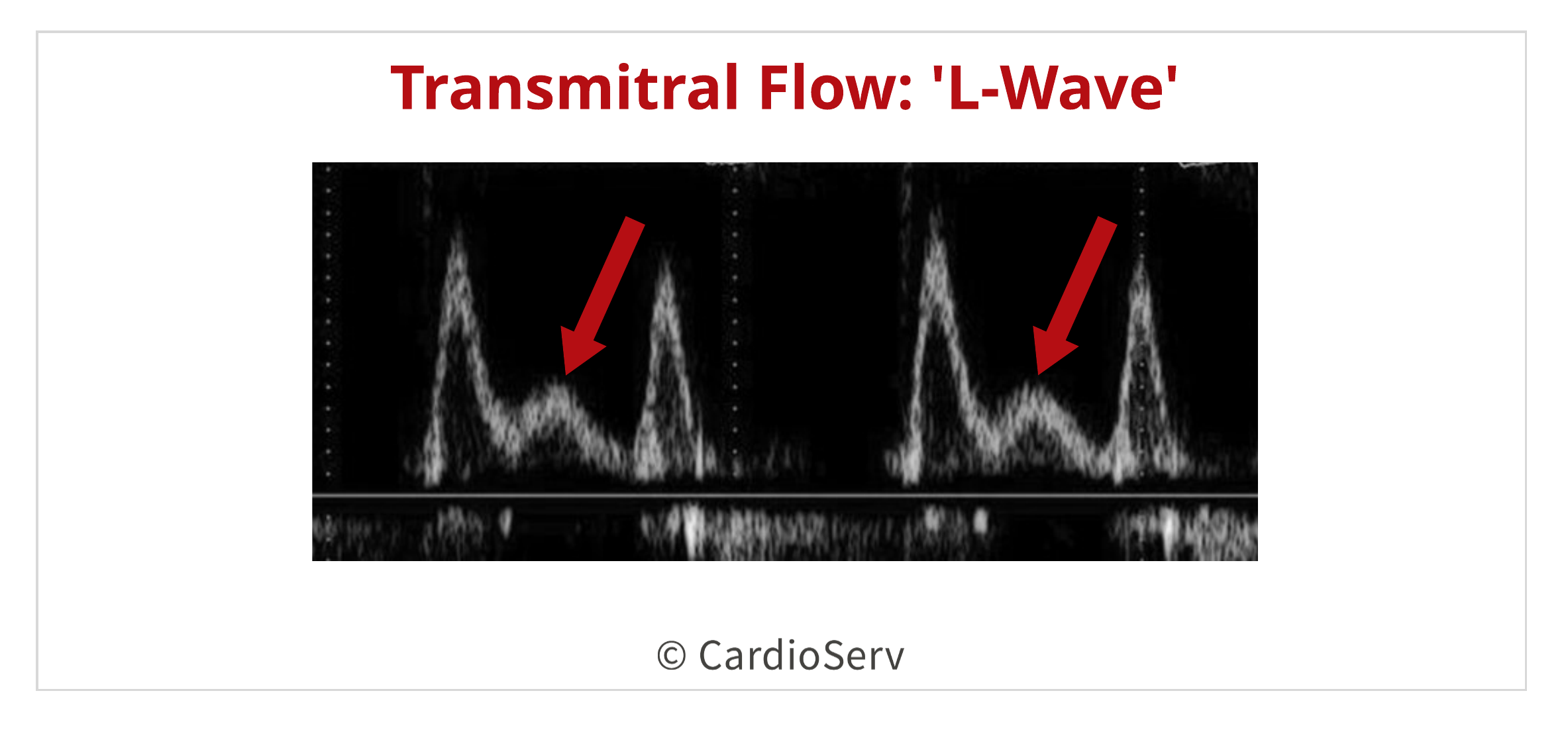Transmitral L Wave Waveform Diastolic Dysfunction