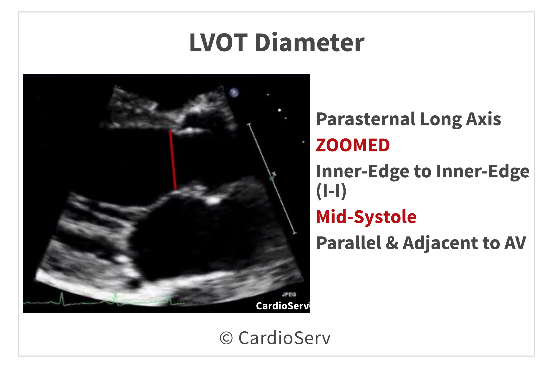 LVOT Diameter Echo