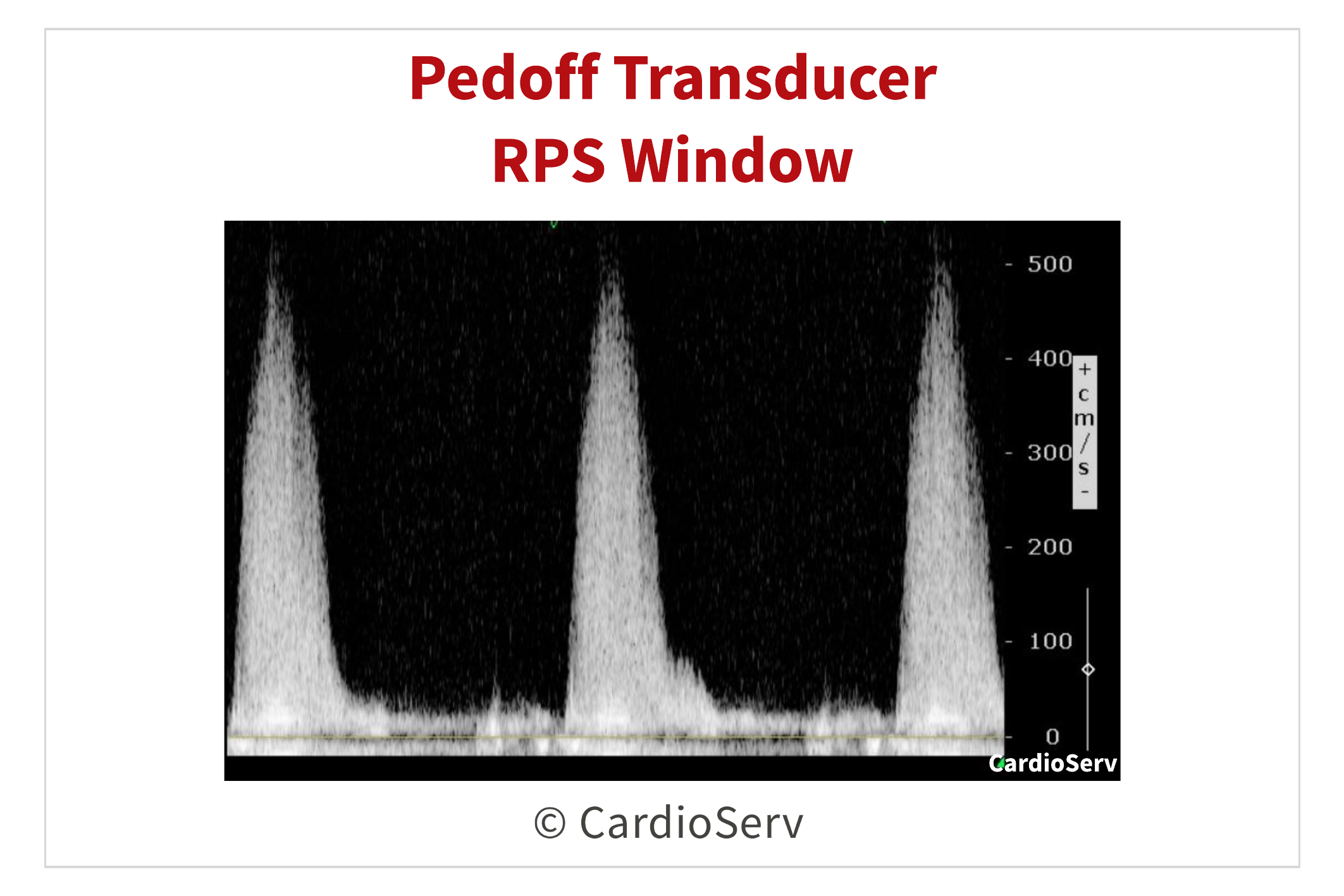 RPS Pedoff CW Doppler Aortic Stenosis Echo