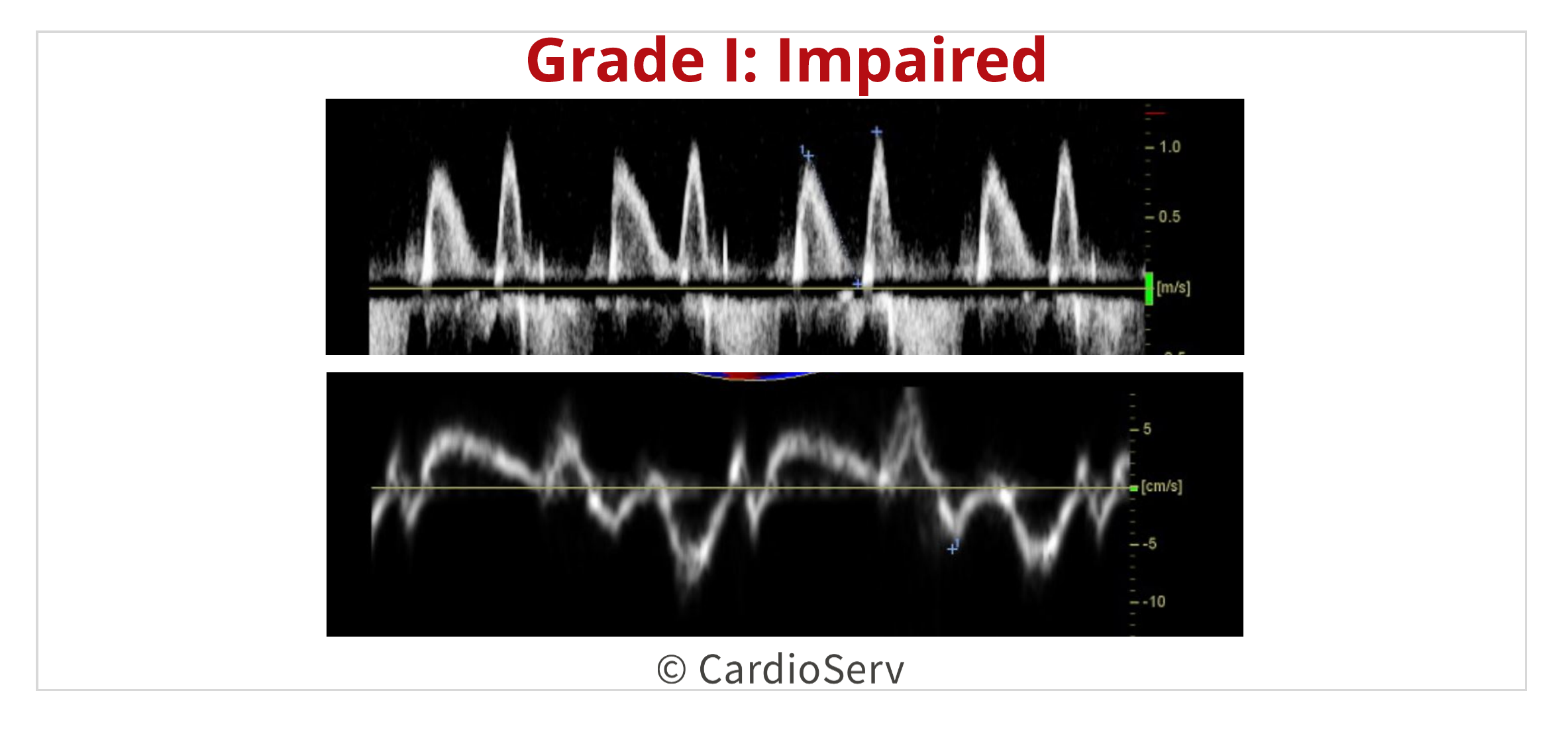 Diastolic Dysfunction Impaired LV Filling Pattern Echo